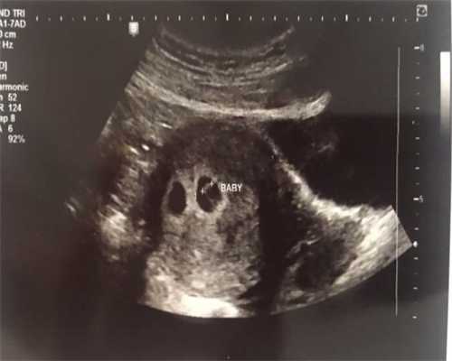 青岛代生公司，试管移植成功后70天是个危险期吗？